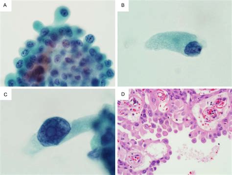 Cytologic Features Of Hobnail Variant Of Papillary Thyroid Carcinoma In