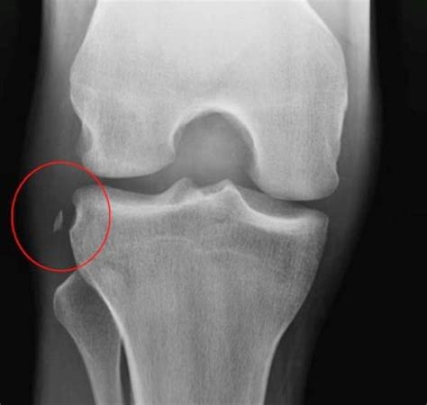 Reconstru O Combinada Intra E Extra Articular Do Ligamento Cruzado