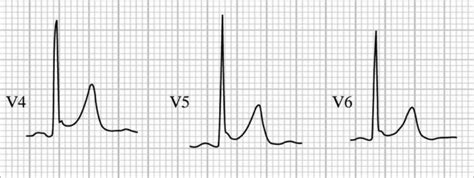 Benign Early Repolarisation • Litfl • Ecg Library Diagnosis