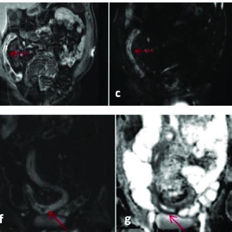 Endoscopic Appearances Of Terminal Ileitis With Aphthous Lesions A B Download Scientific