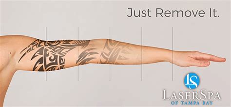 Laser Tattoo Removal Palm Harbor - LaserSpa Palm Harbor