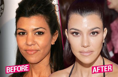 Kourtney Kardashian’s Massive Plastic Surgery Makeover Exposed By Top Docs