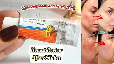 Skinoren Cream Before And After Skinoren Cream Review Youtube