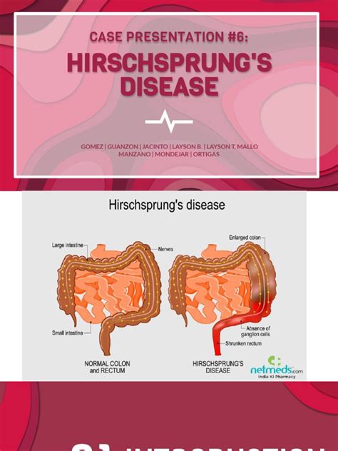 Case Presentation 6 Hirschsprungs Disease 1 Pdf Pdf