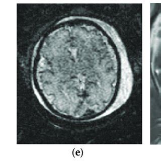 Fetal brain MRI protocol. Normal brain MRI in a 32-week, 6-day GA ...