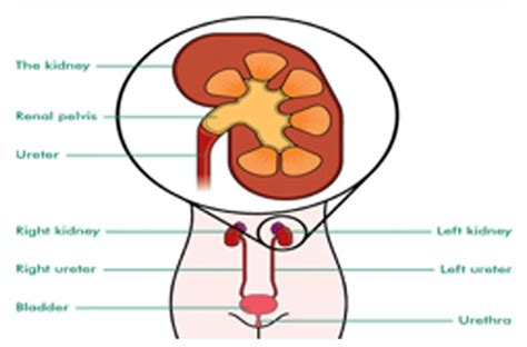 Renal Pelvis Cancer