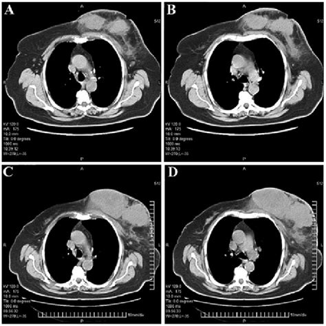 Computed Tomography Ct Scans Of The Chest Prior To And Following Download Scientific Diagram