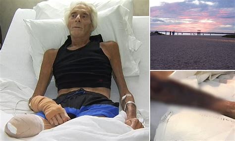 Man Loses His Right Leg To Flesh Eating Bacteria From Swimming On