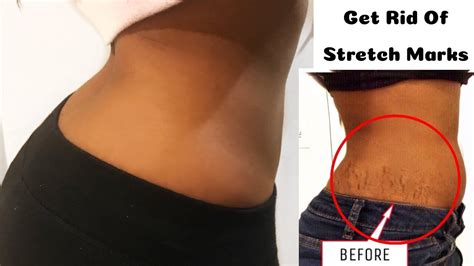 How To Get Rid Of Stretch Marks 5 Natural Ways Youtube