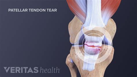 What You Need to Know About Kneecap Injuries