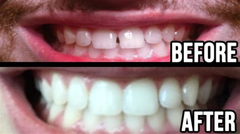 Fixed My Teeth Gap Without Braces 45MIN WORK YouTube