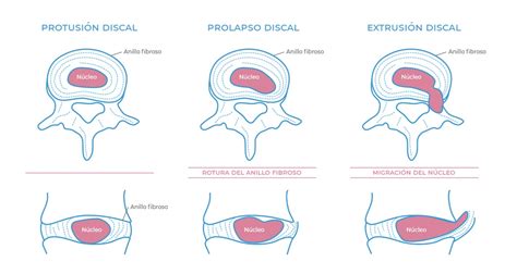 Prolapso Discal Arnoticias Tv