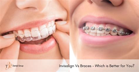 Invisalign Vs Braces Which Is Better For You T32 Dental Group