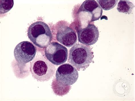 Peritoneal Fluid Extrinsic Cells 2