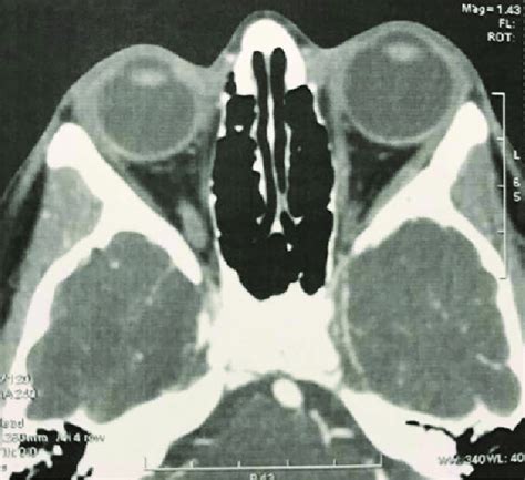 Axial Computerized Tomography CT Scan Shows Left Proptosis And