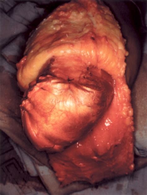 Figure 3 From The Use Of Bone Bridges In Transtibial Amputations Semantic Scholar