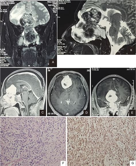 Ethmoid Sinus Malignancy