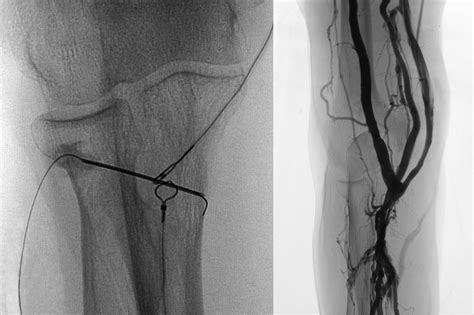 Percutaneous Endovascular Arteriovenous Fistula Creation For Hemodialysis Access Using “off The