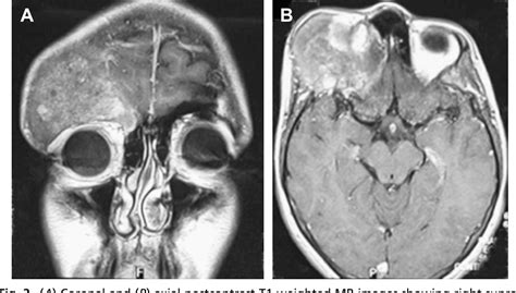 Fibrous Dysplasia Of The Sphenoid And Skull Base Semantic Scholar