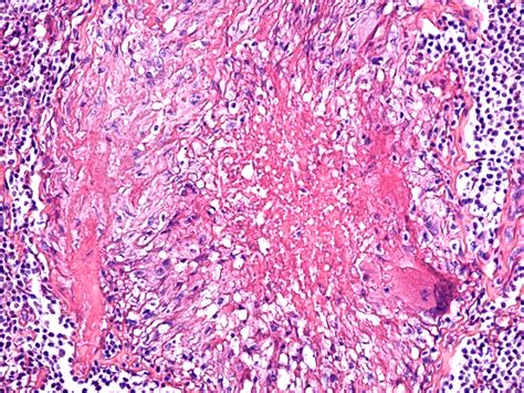 Large Area Of Necrosis With Caseum And A Large Multinucleate Cell