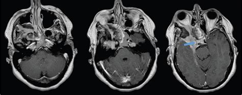 Sellar Parasellar And Clival Region Radiology Key