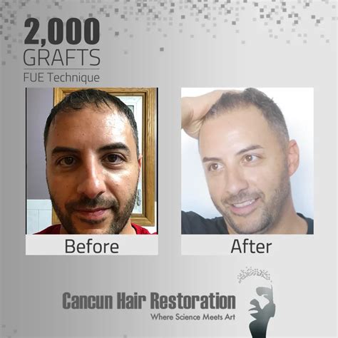 Fue Results Cancun Hair Restoration