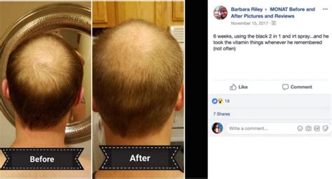 Regrow Hair Products 7 Real Men Tell All With Before After Pictures