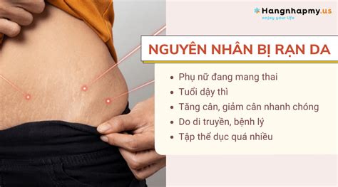 Rạn da là gì Nguyên nhân và cách điều trị rạn da an toàn hiệu quả