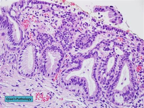 Qiao S Pathology Microglandular Hyperplasia Of Cervix Flickr