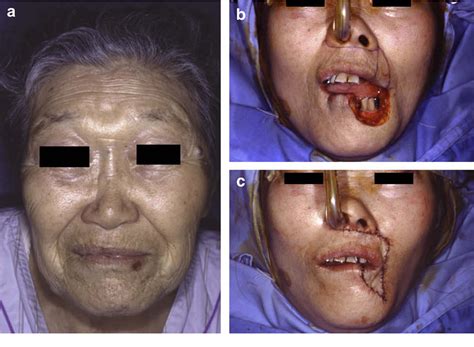 Figure 3 From Estlander Flap Combined With An Extended Upper Lip Flap