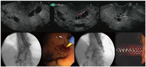 Endoscopic Ultrasound Eus Guided Hepatico Gastrostomy Is Demonstrated