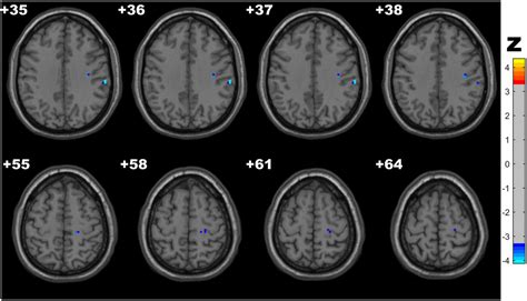 Frontiers Altered Spontaneous Brain Activity Related To Neurologic