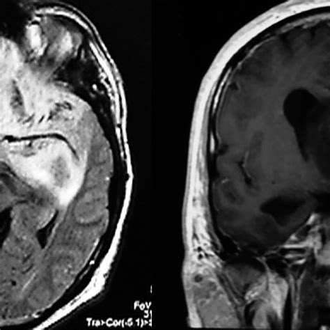 A Axial View T2 Weighted Brain Mri Showing A Hyperintense Lesion In