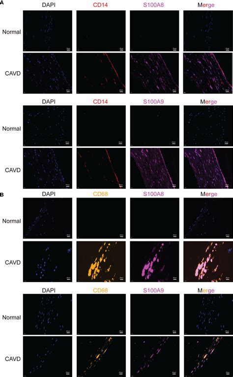 Frontiers Identifying Hub Genes Of Calcific Aortic Valve Disease And