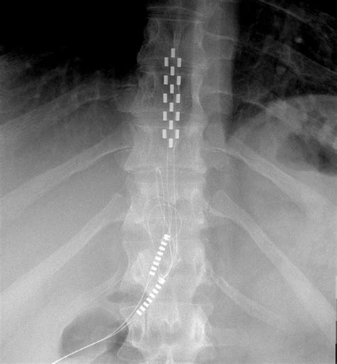 Occipital Nerve Stimulation - Specialist Pain Clinic