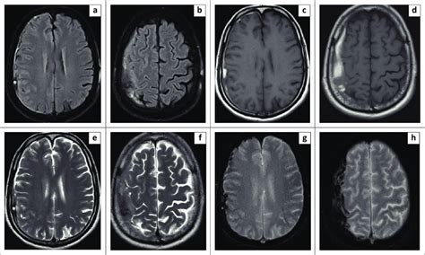 Case Brain Mri In A Year Old Male Patient With Dengue Fever