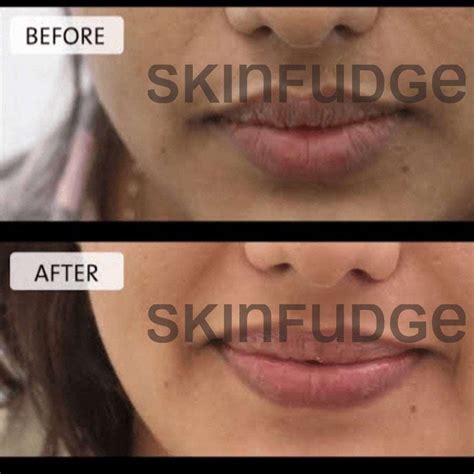 1 Best Lip Lightening Treatment In Lahore Rated ⭐⭐⭐⭐⭐ Skinfudge