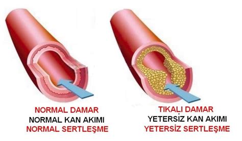 DAMAR TIKANIKLIĞI VE DAMAR HASTALIKLARINA BİREBİR