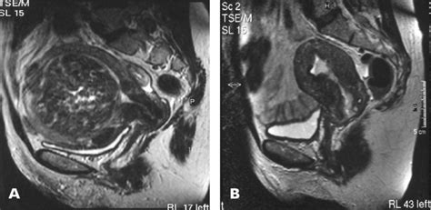 T2 Weighted Sagittal Mri Scan Of The Uterus Before A And After B