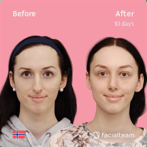 Experts In Facial Feminization Surgery — Facialteam