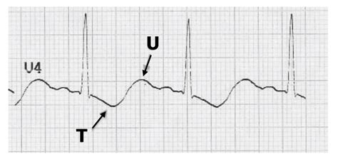 21: A prominent U-wave and inverted T-wave associated with hypokalemia ...