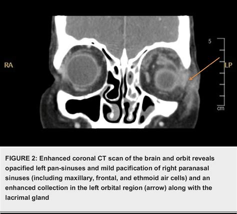 Figure From Non Medial Subperiosteal Abscess In A Year Old Female