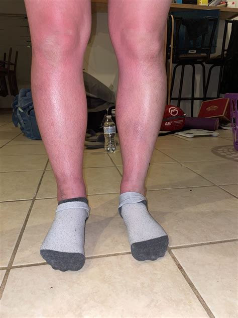 Sun Poisoning Help Rmedical