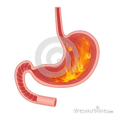 Realistic Medical Illustration Of Pyrosis Stomach Isolated Fire