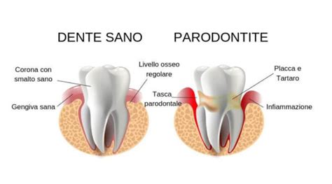 Tasche Gengivali Cosa Sono E Come Curarle Studio Biodental