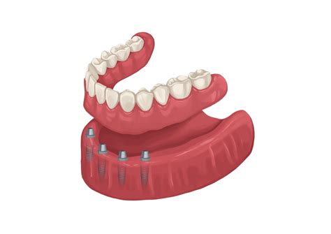 Picture By Authority Dental Under CC 2 0 License