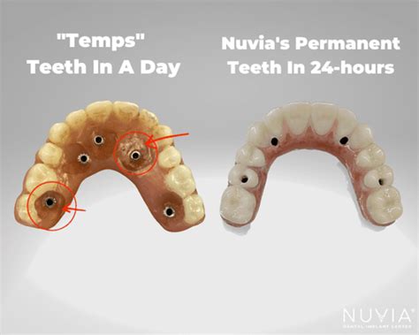 Get Dental Implants In Alexandria In Just Hours With Nuvia