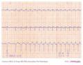 De Voogt Ecg Archive Supraventricular Rhythms Wpw Ecgpedia