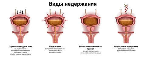 Лечение энуреза в Ставрополе | Neuro-Clinic