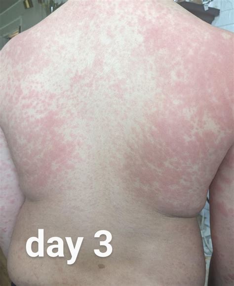 Amoxicillin rash progression : r/DermatologyQuestions